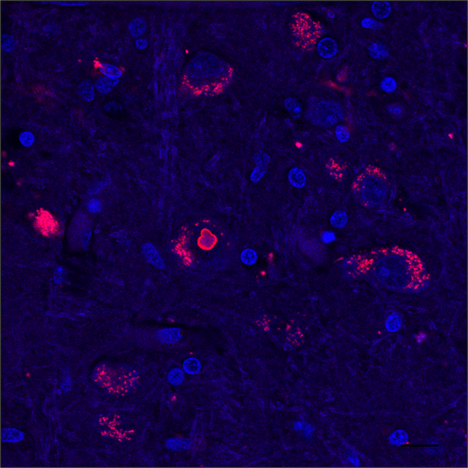 Microscope image of brain tissue showing fluorescent blue cells and red protein speckles on a black background.