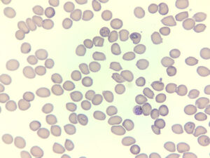 Image of red blood cells (lavender blobs) on a white background. Some of the cells contain malaria parasites (dark purple speckles).